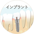 インプラント